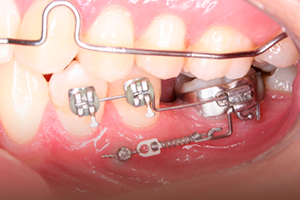 Mini-implantes ortodontico